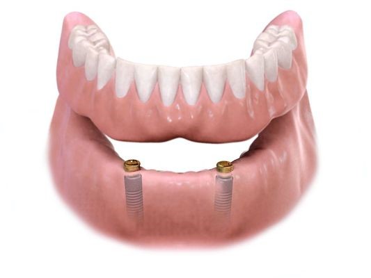 Fixed Dentures Chili WI 54420